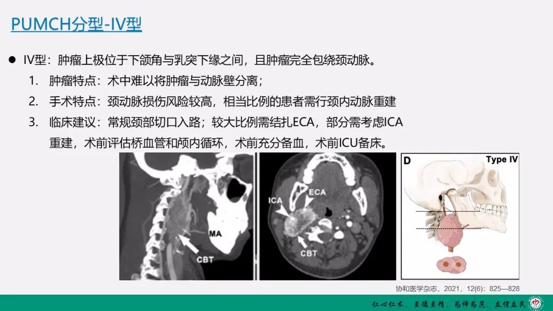 影像PPT - 【PPT】颈动脉体瘤（CBT）影像表现及临床分型-21