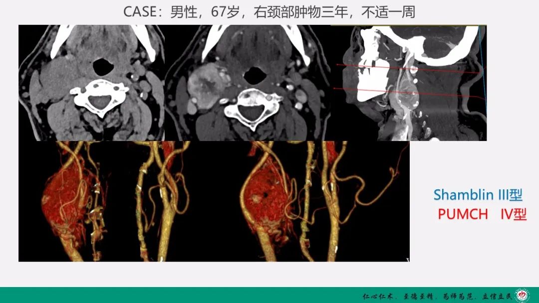 影像PPT - 【PPT】颈动脉体瘤（CBT）影像表现及临床分型-22