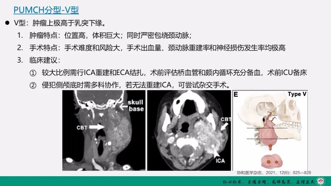 影像PPT - 【PPT】颈动脉体瘤（CBT）影像表现及临床分型-23