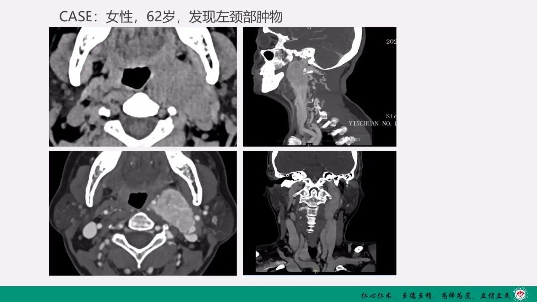 影像PPT - 【PPT】颈动脉体瘤（CBT）影像表现及临床分型-24
