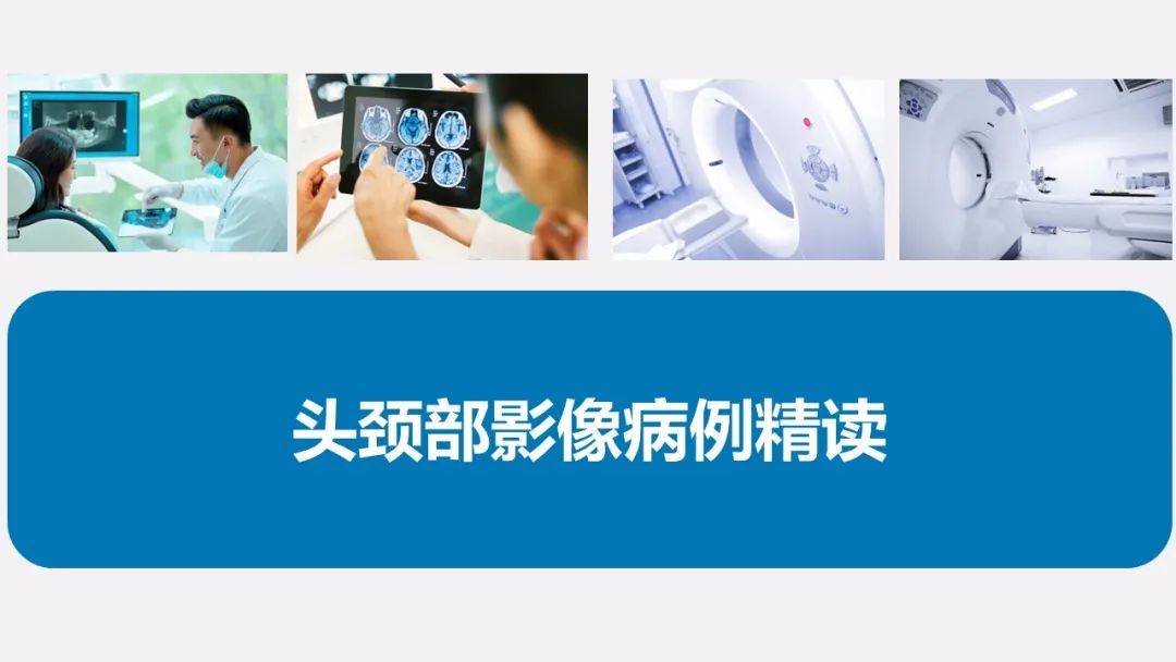 影像PPT - 【PPT】颈动脉体瘤（CBT）影像表现及临床分型-26