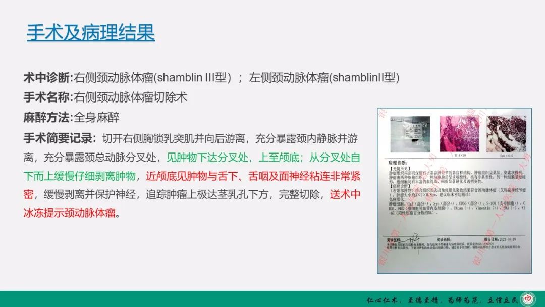 影像PPT - 【PPT】颈动脉体瘤（CBT）影像表现及临床分型-30