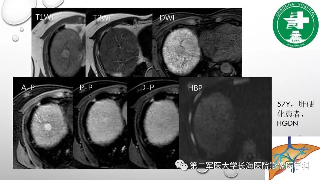 影像PPT - 【PPT】肝胆特异性MRI对比剂—钆塞酸二钠Gd-EOB-DTPA-17