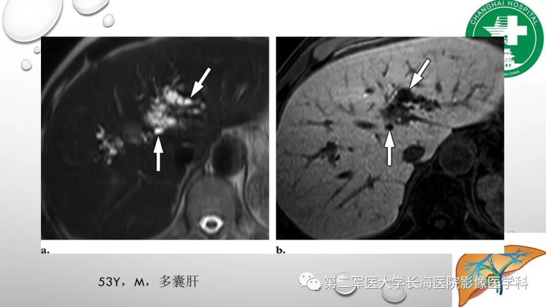 影像PPT - 【PPT】肝胆特异性MRI对比剂—钆塞酸二钠Gd-EOB-DTPA-31