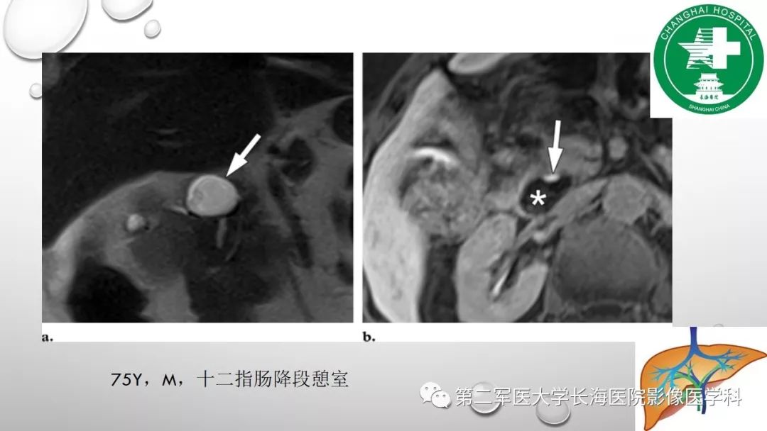 影像PPT - 【PPT】肝胆特异性MRI对比剂—钆塞酸二钠Gd-EOB-DTPA-33