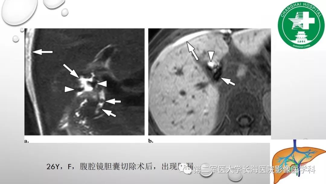 影像PPT - 【PPT】肝胆特异性MRI对比剂—钆塞酸二钠Gd-EOB-DTPA-34
