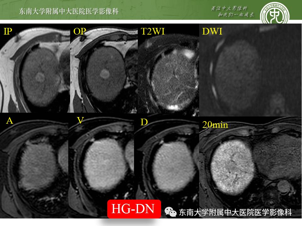 影像PPT - 【PPT】肝胆特异性MRI对比剂—钆塞酸二钠Gd-EOB-DTPA-49