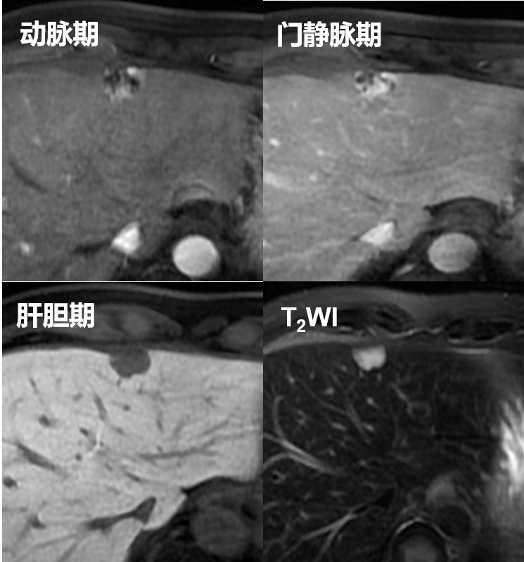 影像PPT - 【PPT】肝胆特异性MRI对比剂—钆塞酸二钠Gd-EOB-DTPA-64