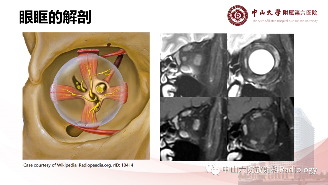 影像PPT - 【PPT】眶内血管瘤影像学表现-5