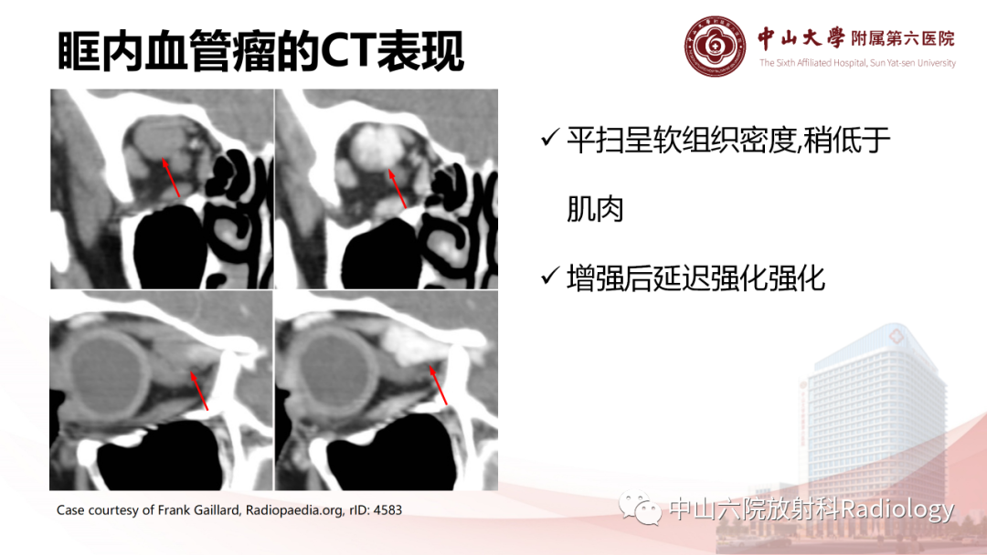 影像PPT - 【PPT】眶内血管瘤影像学表现-10
