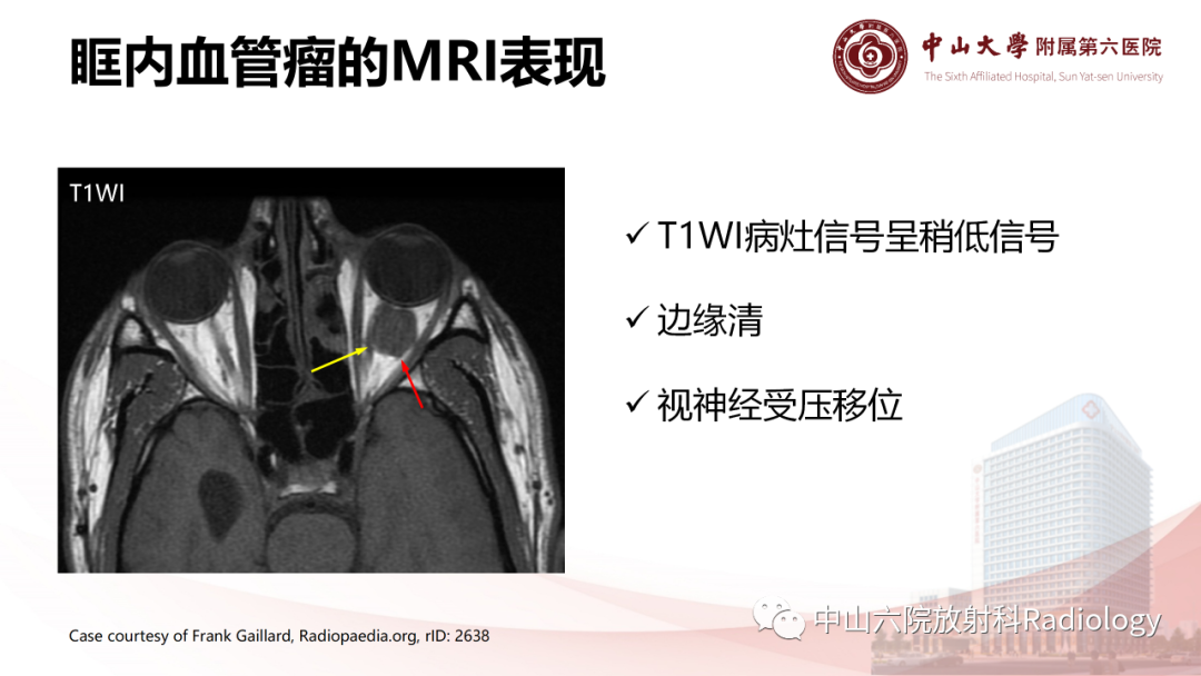 影像PPT - 【PPT】眶内血管瘤影像学表现-11