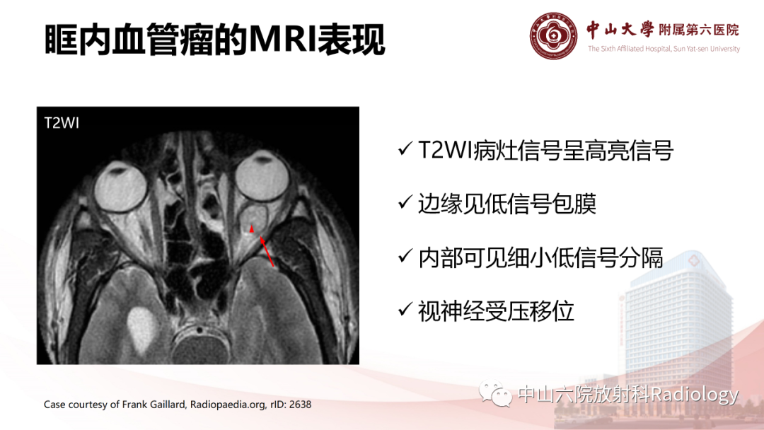 影像PPT - 【PPT】眶内血管瘤影像学表现-12