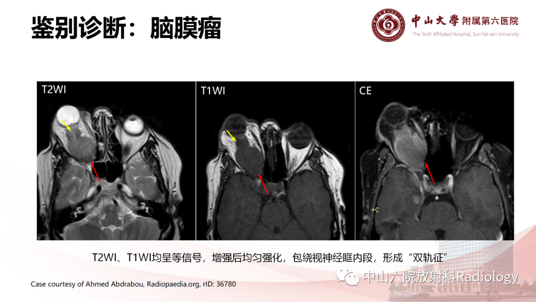 影像PPT - 【PPT】眶内血管瘤影像学表现-16
