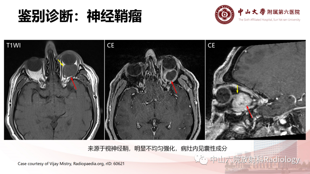 影像PPT - 【PPT】眶内血管瘤影像学表现-17