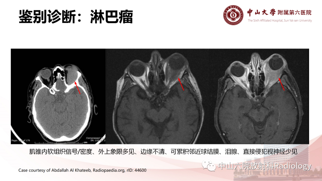 影像PPT - 【PPT】眶内血管瘤影像学表现-18