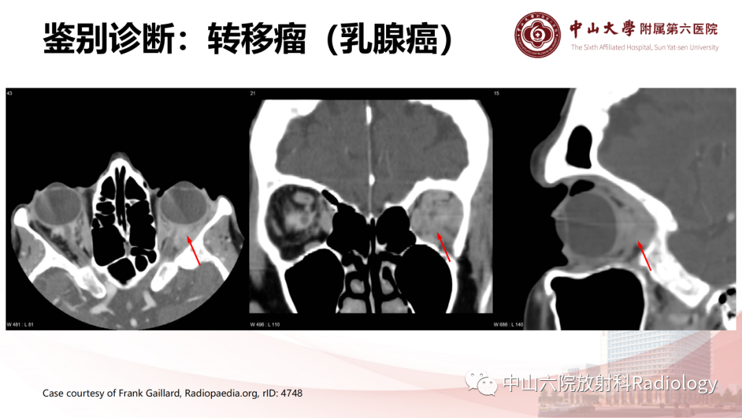 影像PPT - 【PPT】眶内血管瘤影像学表现-19