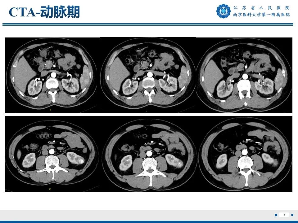 影像PPT - 【PPT】透明细胞癌-4