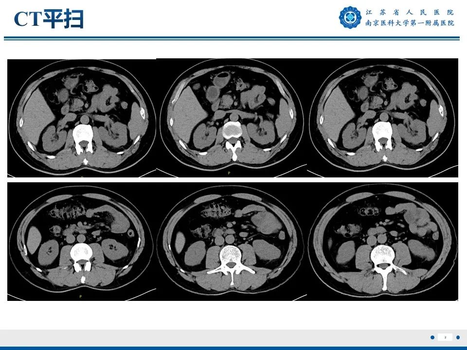 影像PPT - 【PPT】透明细胞癌-3