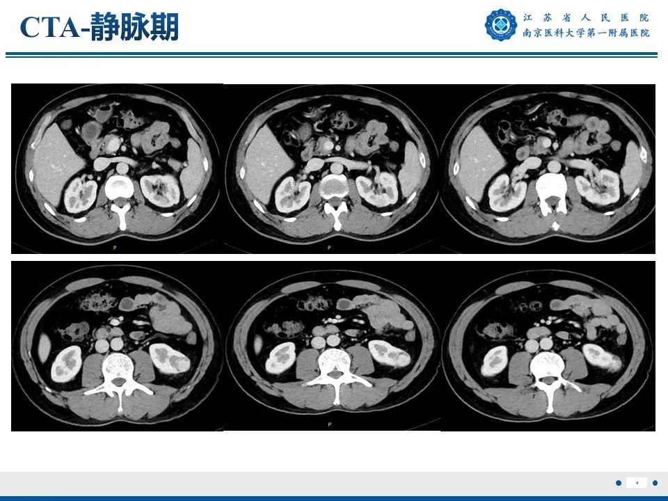 影像PPT - 【PPT】透明细胞癌-5