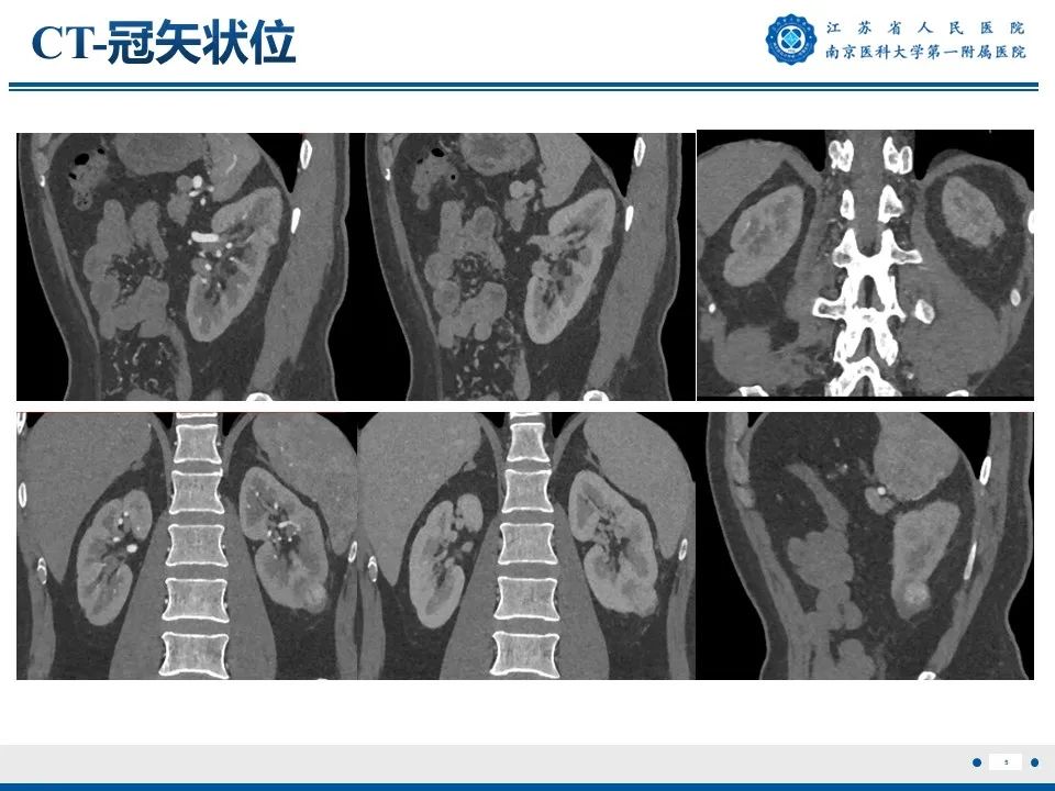影像PPT - 【PPT】透明细胞癌-6