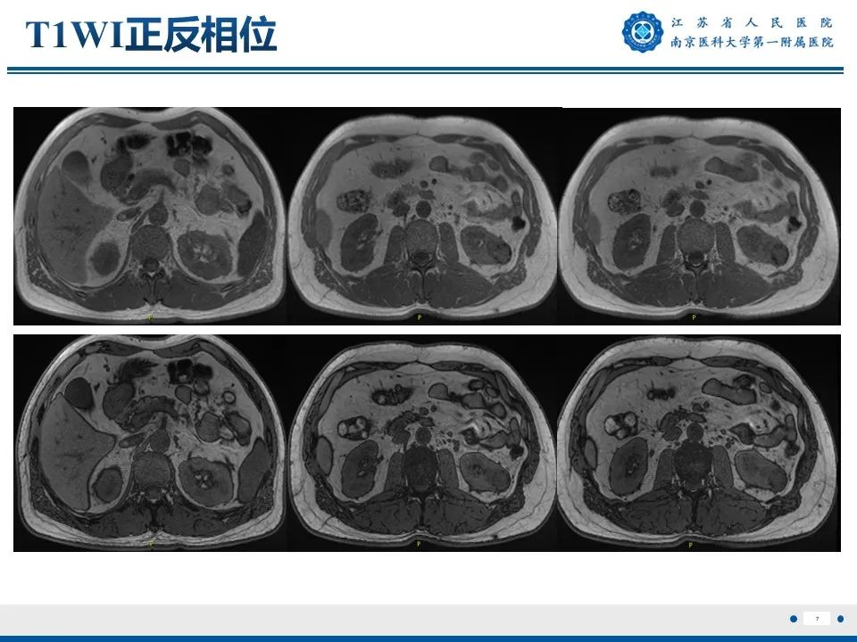 影像PPT - 【PPT】透明细胞癌-8