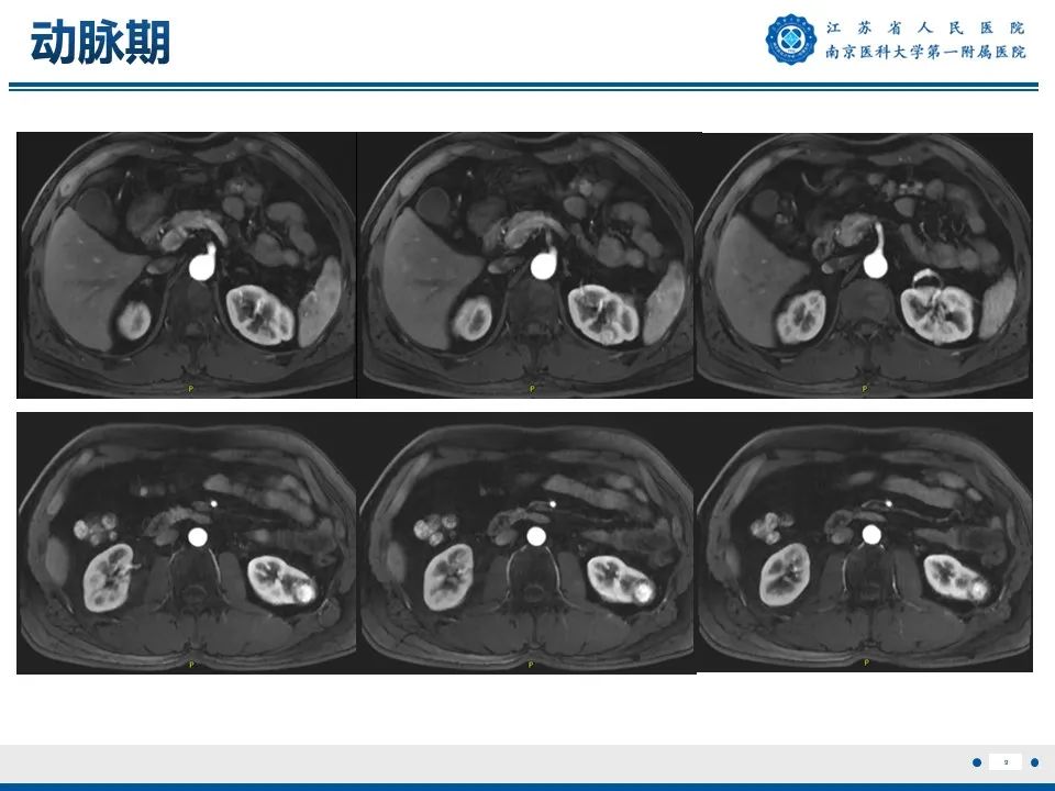 影像PPT - 【PPT】透明细胞癌-10