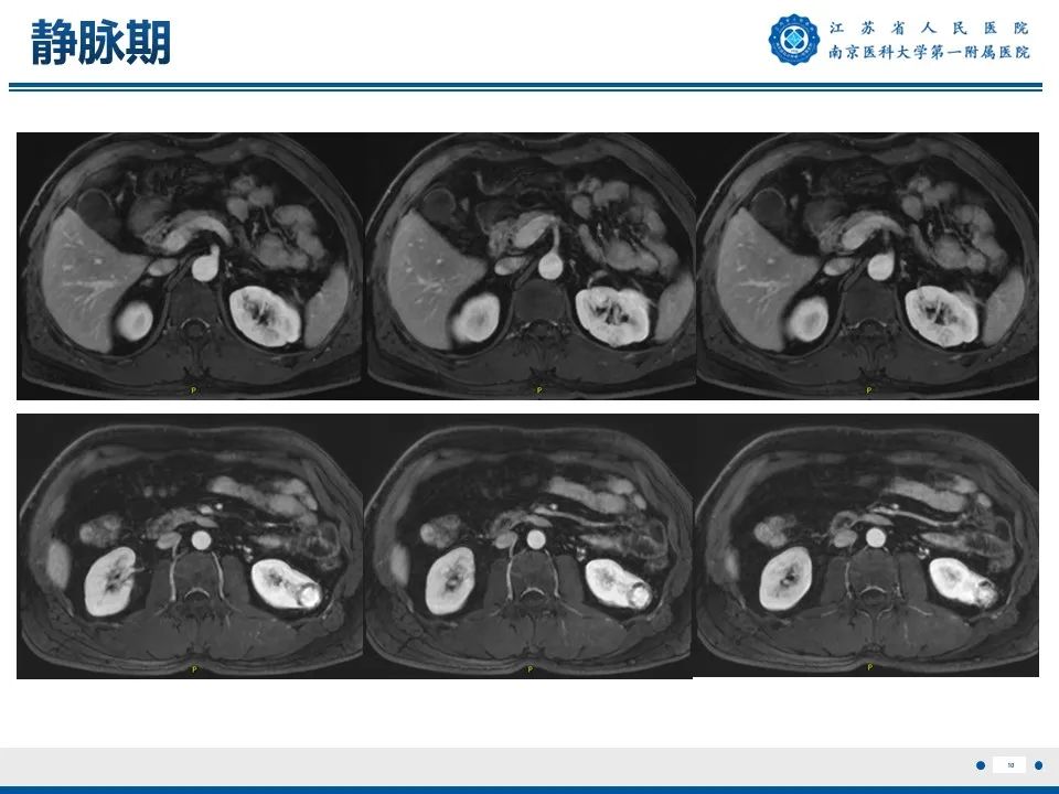 影像PPT - 【PPT】透明细胞癌-11
