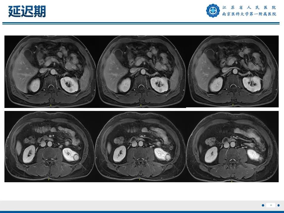 影像PPT - 【PPT】透明细胞癌-12