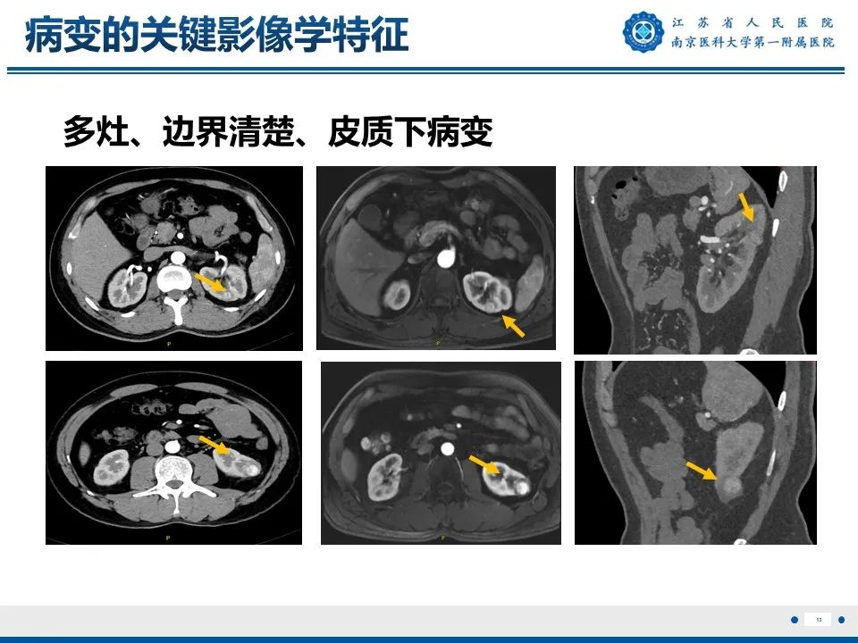 影像PPT - 【PPT】透明细胞癌-14