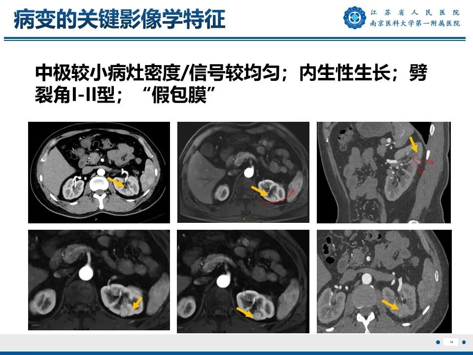影像PPT - 【PPT】透明细胞癌-15