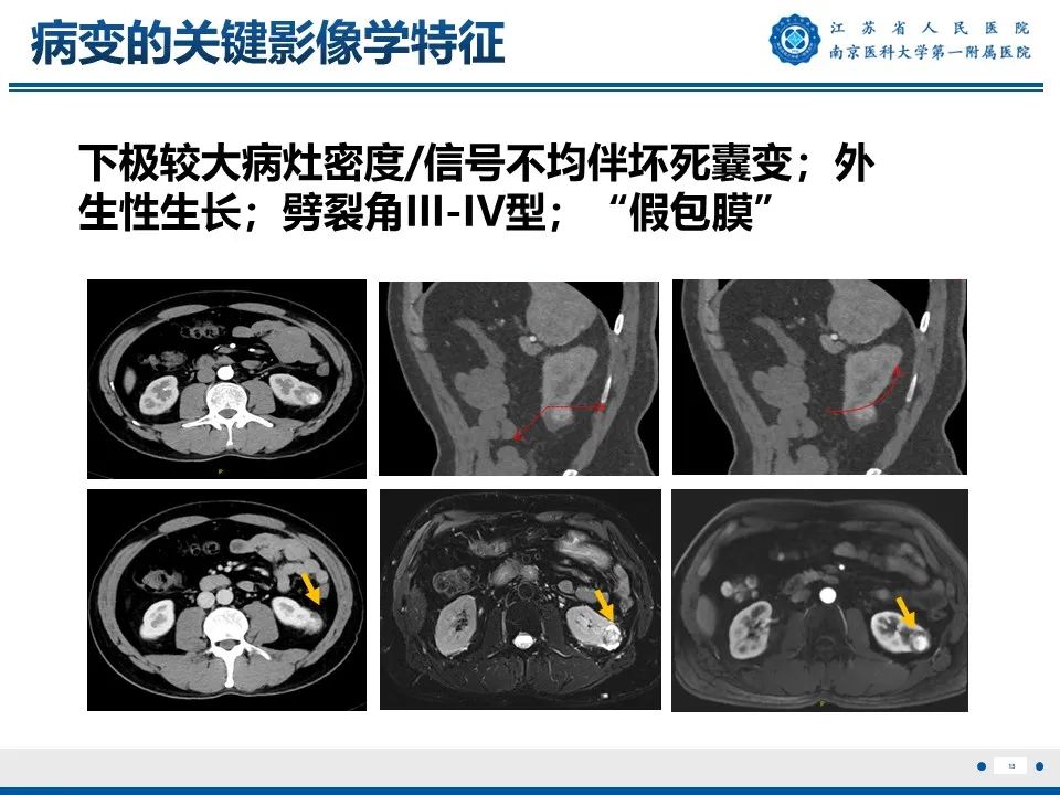 影像PPT - 【PPT】透明细胞癌-16