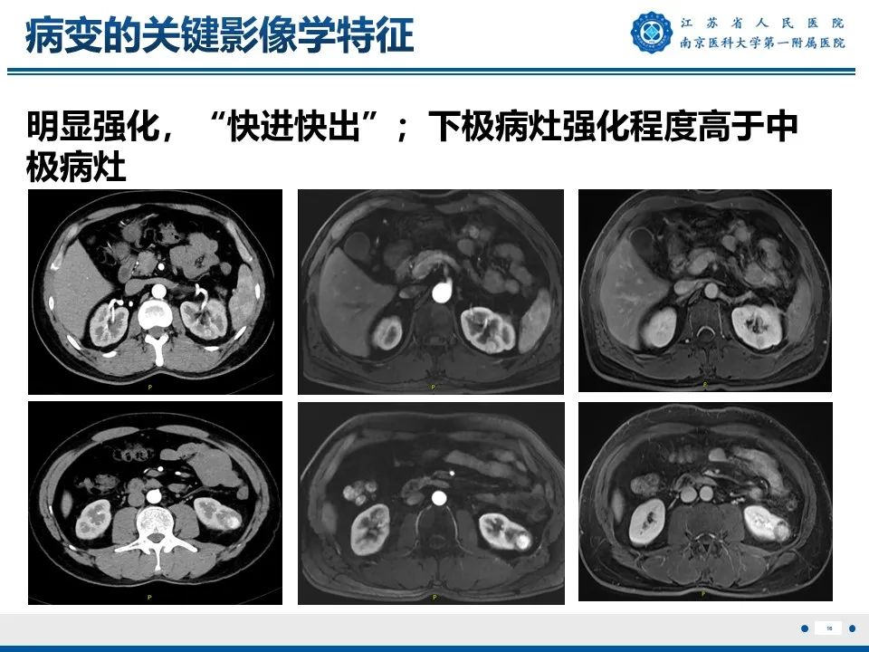 影像PPT - 【PPT】透明细胞癌-17