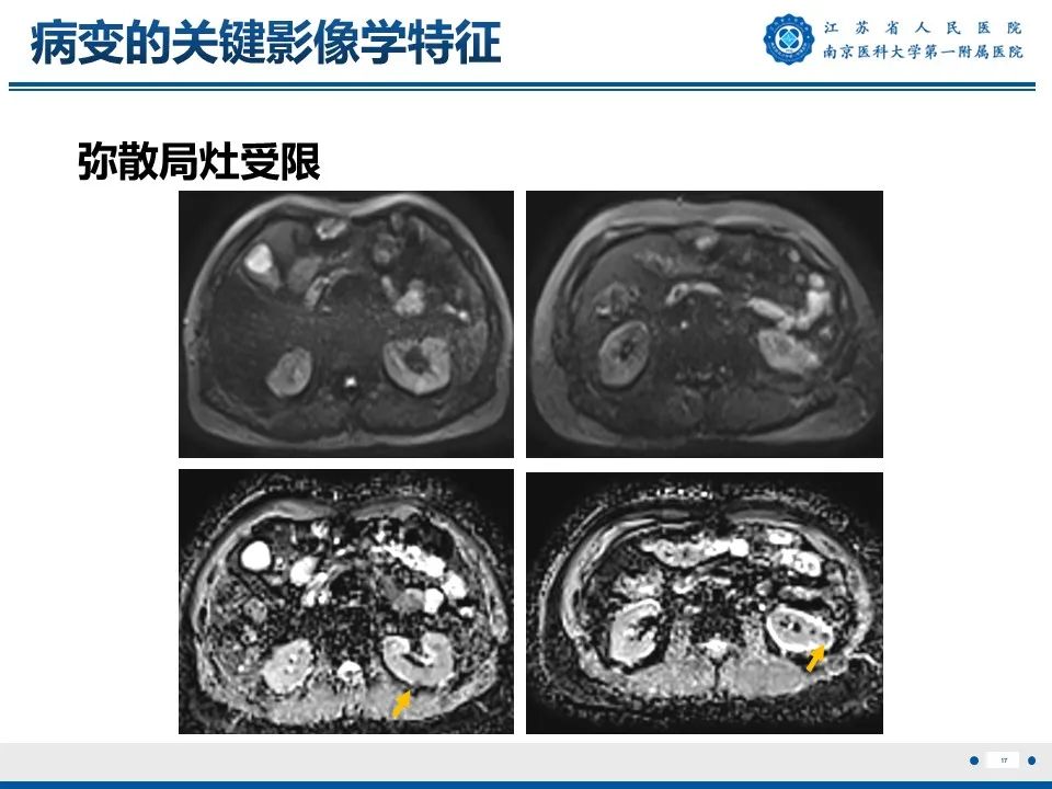 影像PPT - 【PPT】透明细胞癌-18