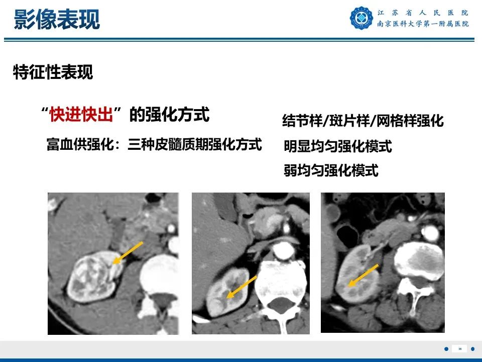 影像PPT - 【PPT】透明细胞癌-37
