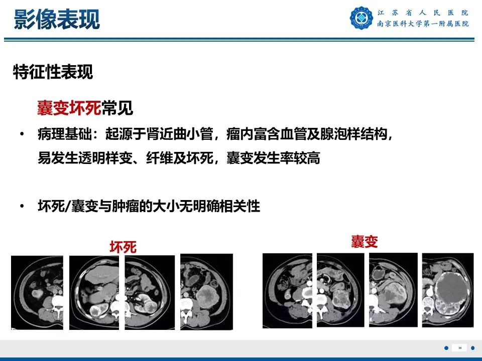 影像PPT - 【PPT】透明细胞癌-39