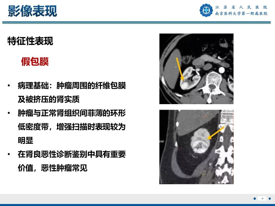 影像PPT - 【PPT】透明细胞癌-40