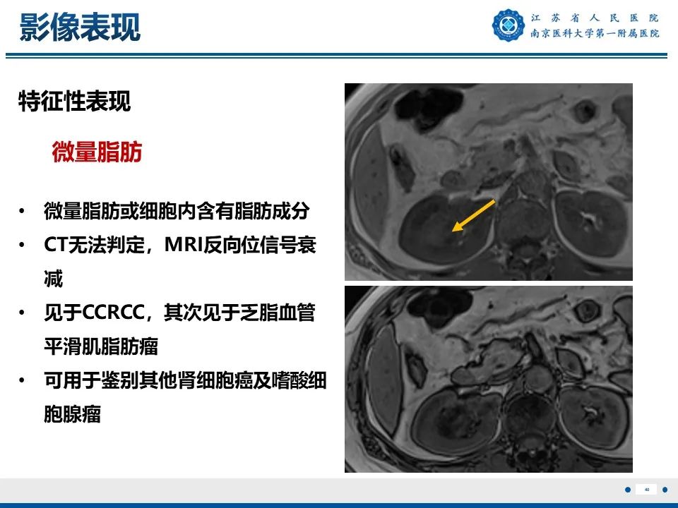 影像PPT - 【PPT】透明细胞癌-41