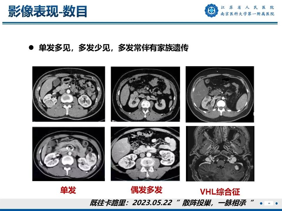 影像PPT - 【PPT】透明细胞癌-45
