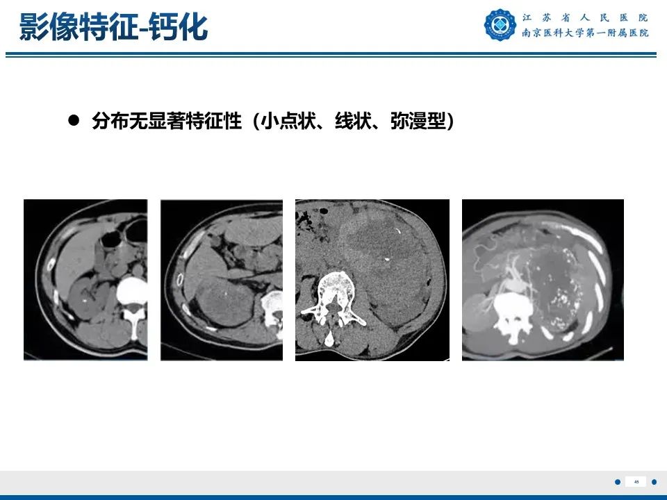 影像PPT - 【PPT】透明细胞癌-46