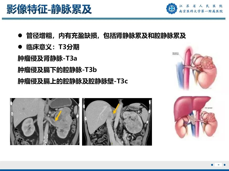 影像PPT - 【PPT】透明细胞癌-47