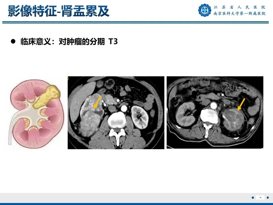 影像PPT - 【PPT】透明细胞癌-48
