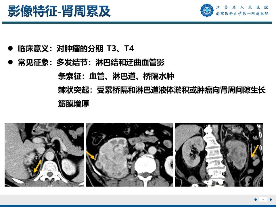 影像PPT - 【PPT】透明细胞癌-49
