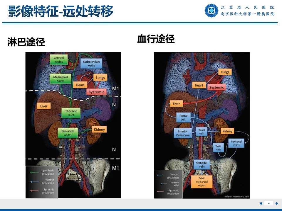 影像PPT - 【PPT】透明细胞癌-50