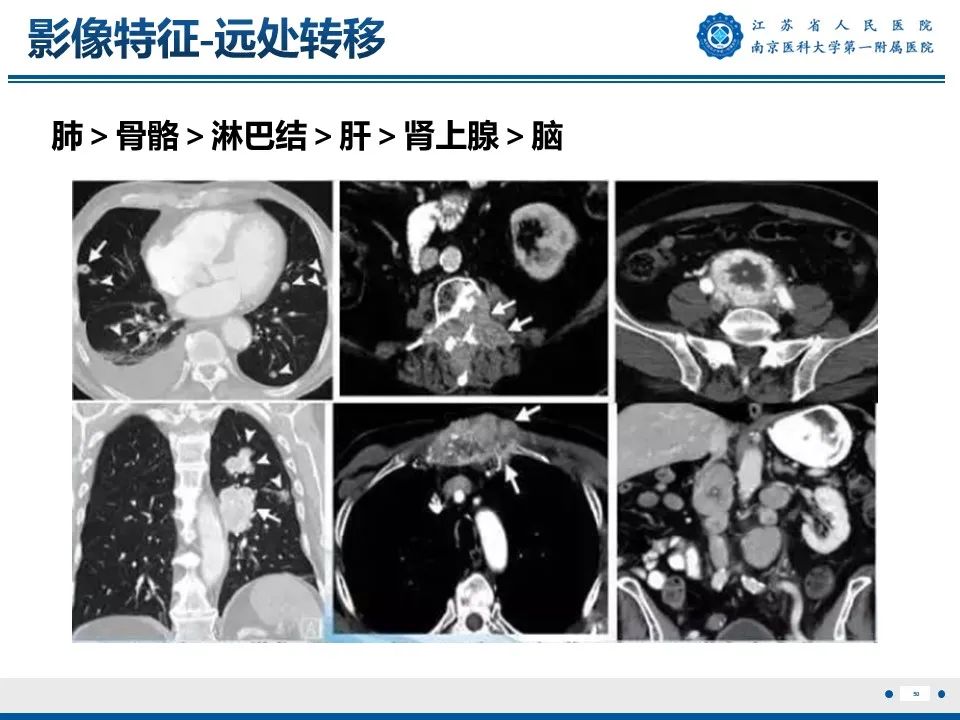 影像PPT - 【PPT】透明细胞癌-51