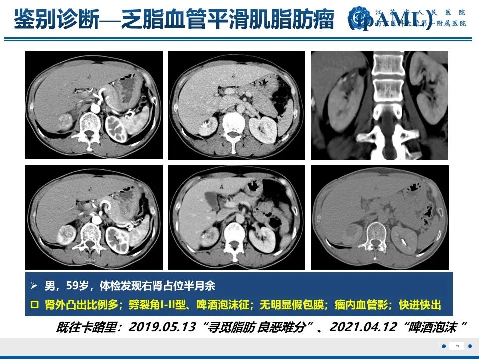 影像PPT - 【PPT】透明细胞癌-54