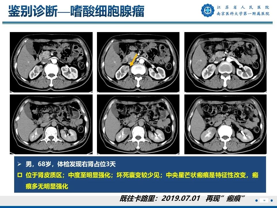 影像PPT - 【PPT】透明细胞癌-56