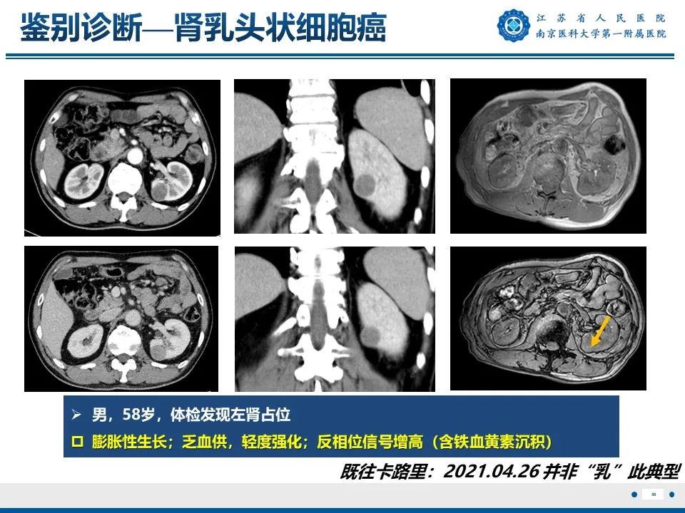 影像PPT - 【PPT】透明细胞癌-57
