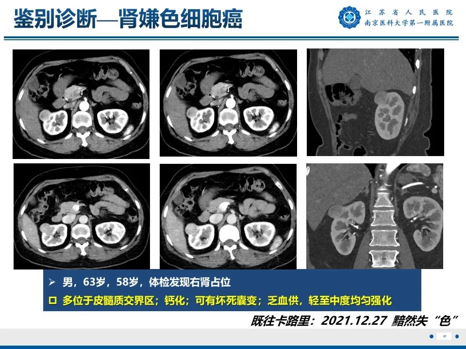 影像PPT - 【PPT】透明细胞癌-58