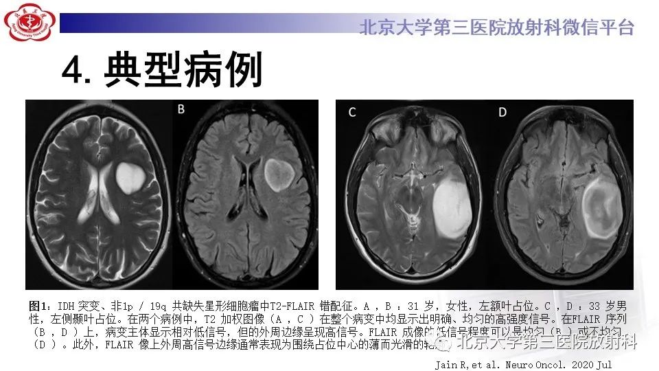 影像PPT - 【PPT】低级别星形细胞瘤中的T2/Flair不匹配征-9