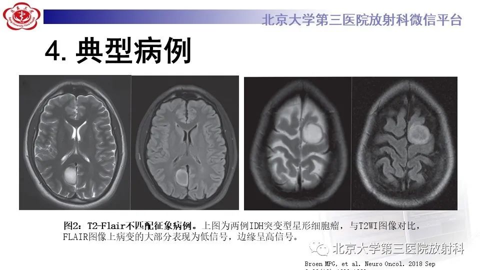 影像PPT - 【PPT】低级别星形细胞瘤中的T2/Flair不匹配征-10
